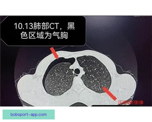 坎宁安气胸恢复顺利 活塞官方公布复查时间和复出计划